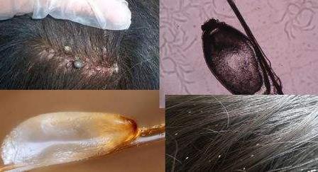 头上长虱子怎么办?虱子怎么去除?去虱子和虱子卵的有效方法