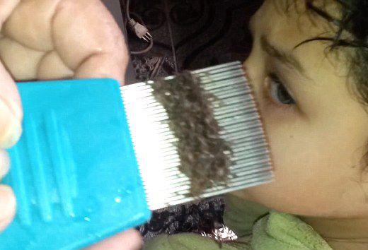 头上长虱子怎么办?虱子怎么去除?去虱子和虱子卵的有效方法