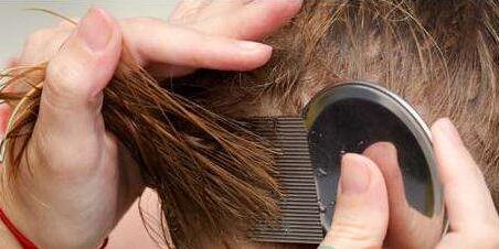 头上长虱子怎么办?虱子怎么去除?去虱子和虱子卵的有效方法