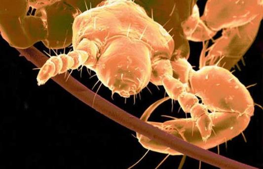 头上长虱子怎么办?虱子怎么去除?去虱子和虱子卵的有效方法