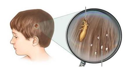 头上长虱子怎么办?虱子怎么去除?去虱子和虱子卵的有效方法