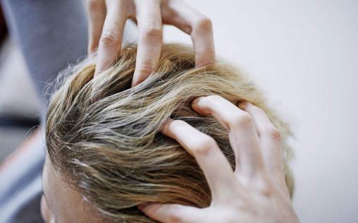 头屑很严重满头都是怎么办?4个好方法帮你来应对